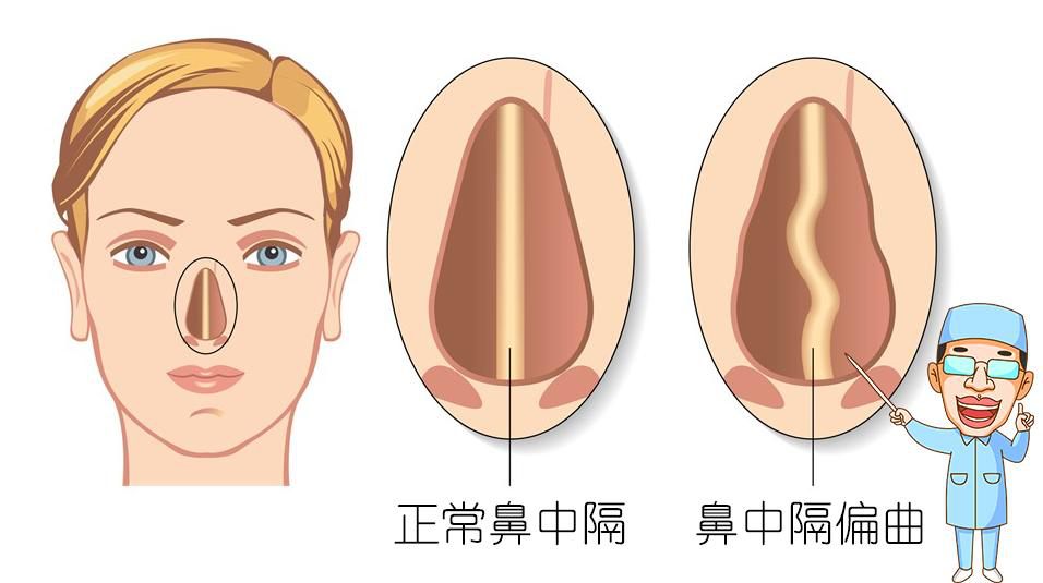 廣義的鼻腔,鼻竇結構異常應該包括兩個方面:其一是解剖結構發育異常