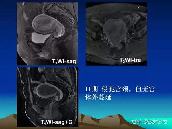子宫常见疾病的MRI诊断 - 知乎