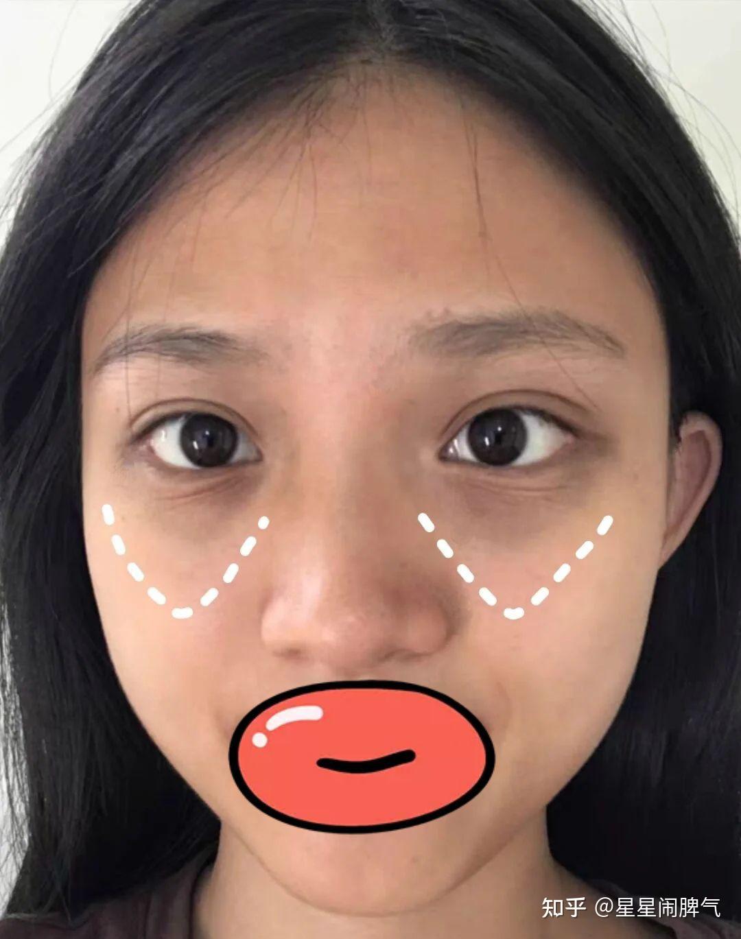 黑眼圈特别重怎么办