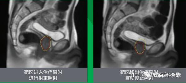 MRIdian Linac 磁共振引导放疗系统介绍 - 知乎