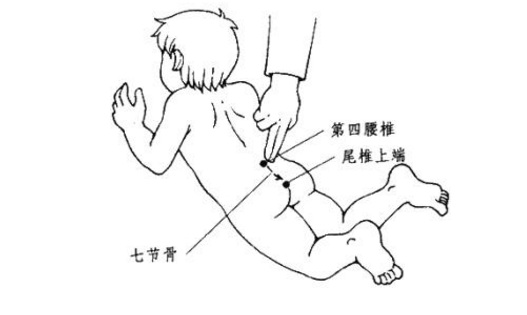 脊柱裂常见的症状有哪些