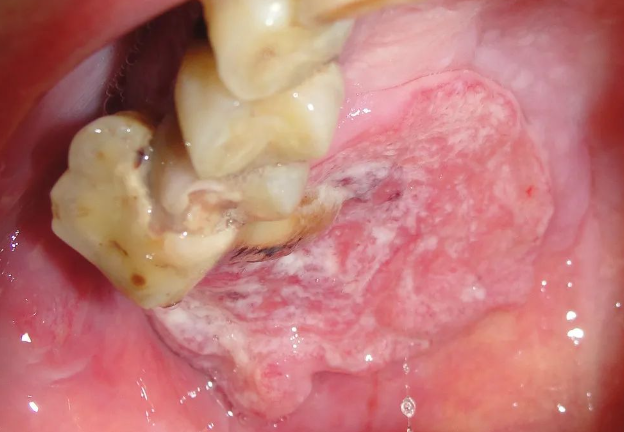 口腔溃疡和口腔癌照片图片
