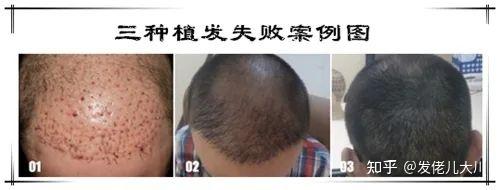 【植发4年了】本文不推荐任何人植发，也不推荐任何植发机构，只揭底植发全过程！ - 知乎