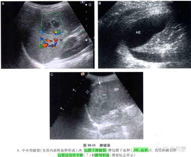 超声诊断学知识点总结(脾脏)