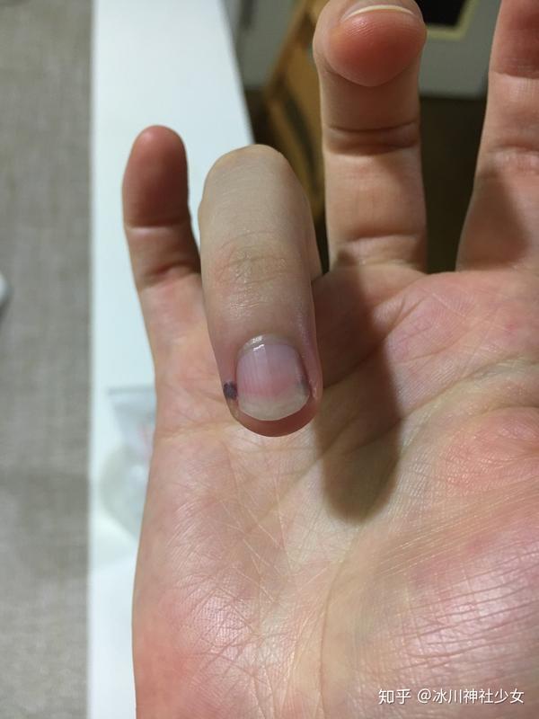 手指被夹紧急处理法方法