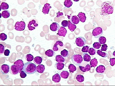 慢性淋巴细胞白血病治疗药物gazyvaobinutuzumab奥滨尤妥珠单抗