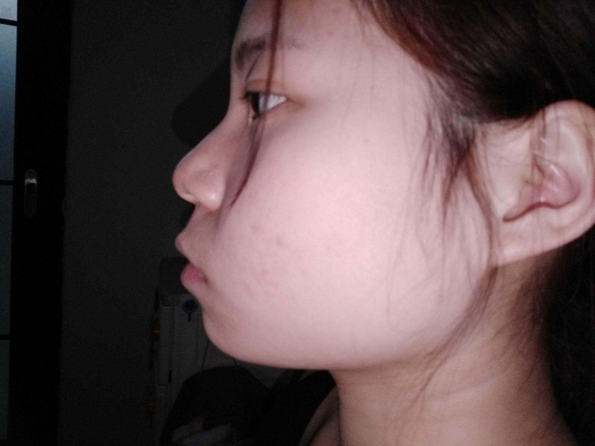 龅牙凸嘴怎么改善侧脸