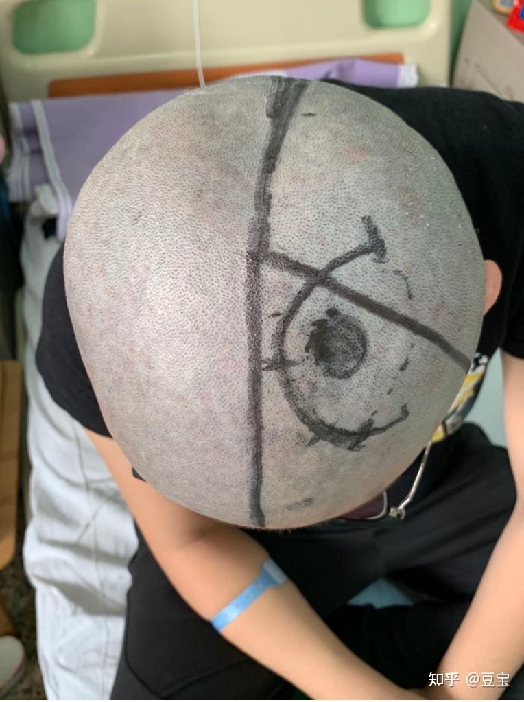 开颅手术后的一年半时间