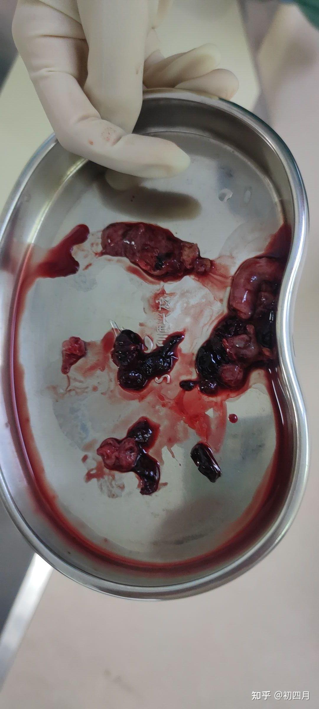卵巢囊肿排出异物图片图片
