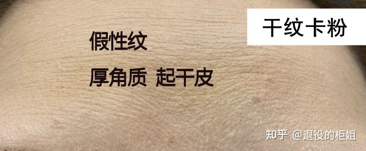 第二层级缺水表现:干纹,假性纹