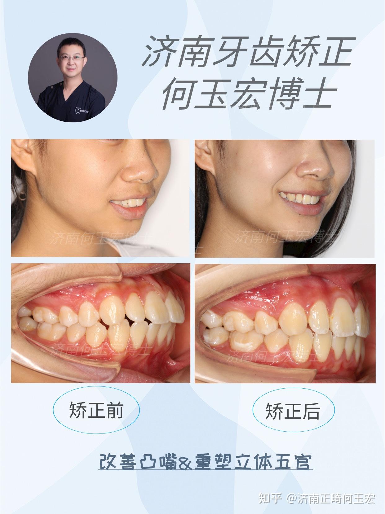 陈剑阳案例集：主诉牙齿凸、前牙侧切牙对刃 - 知乎