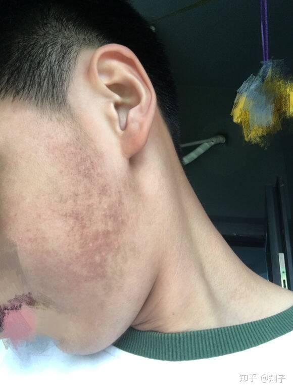 我是一个男生,脸部腮部发红,不痛不痒,不知道怎么回事,有什么方法可以