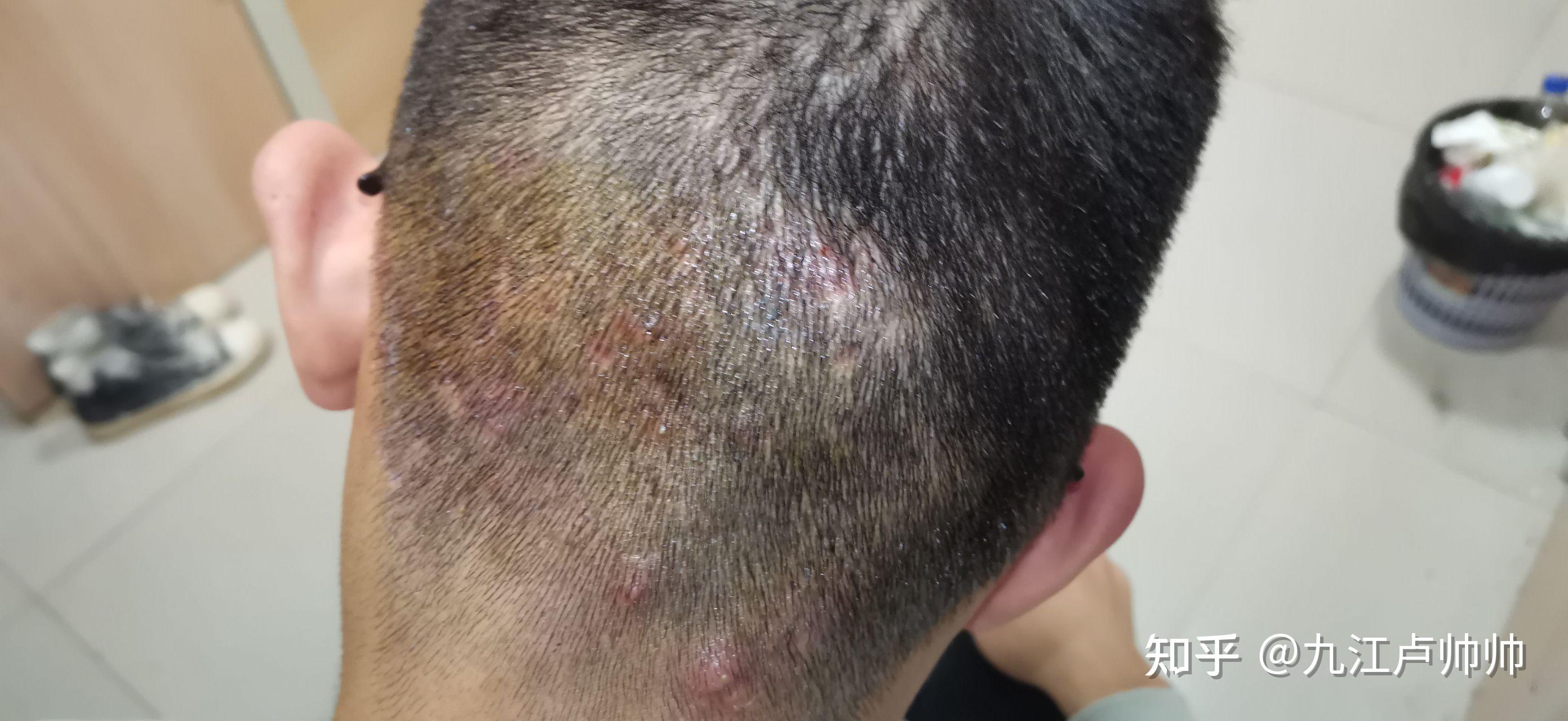 马拉色菌毛囊炎的治愈全过程（亲身经历）图片可能引起不适请谨慎观看 - 知乎