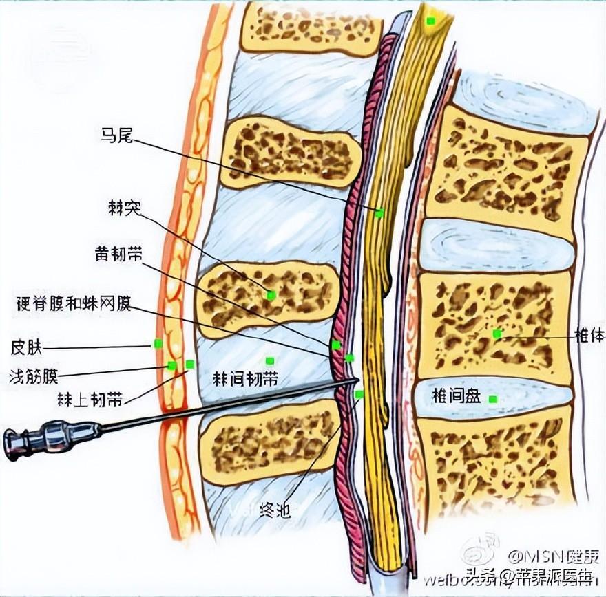 技能考试——腰椎穿刺术