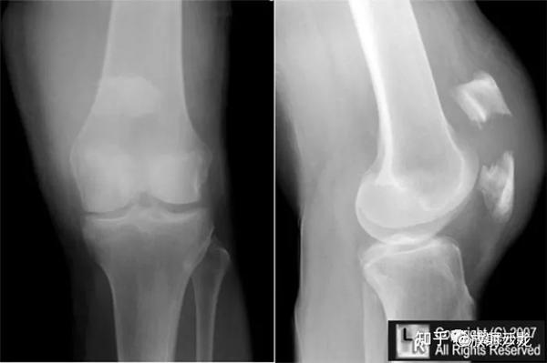 收藏 42种常用骨科鉴别诊断最全总结 知乎