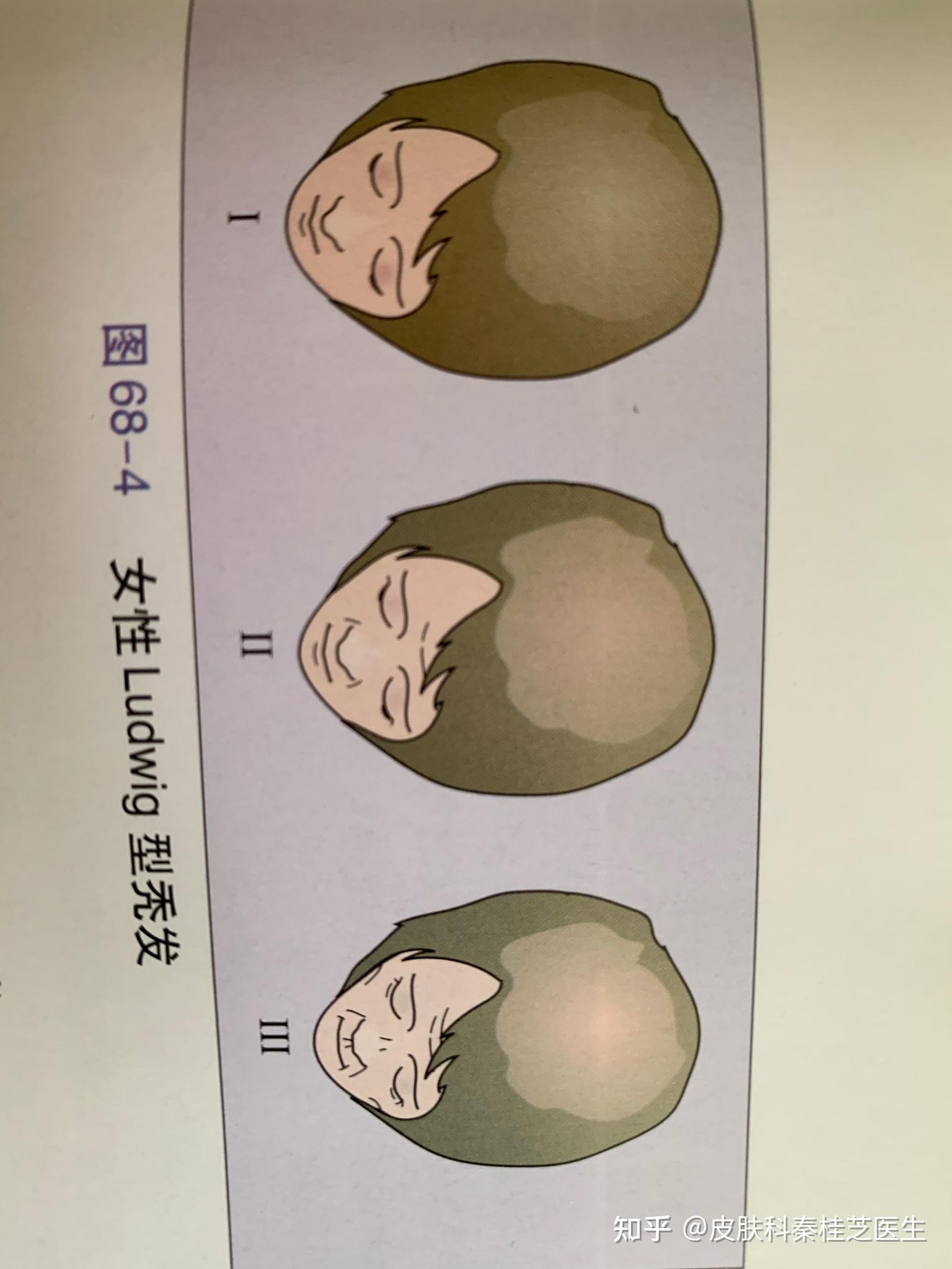 vii:是最严重的类型,可累及耳周及枕后的马蹄形秃发.