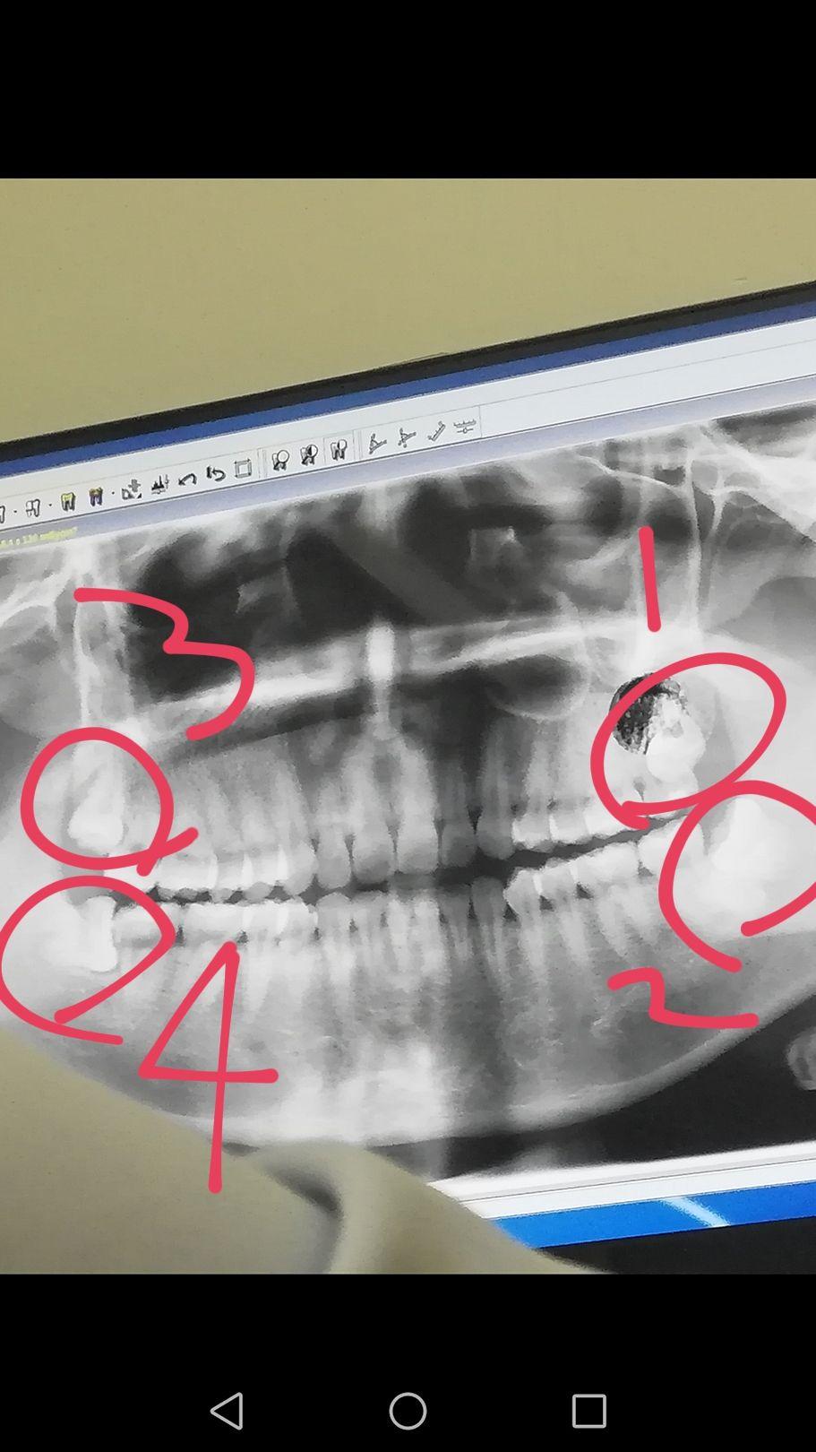 智齿阻生吸收了旁边的牙根,而且旁牙在做根管