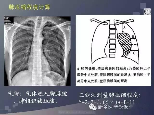 气胸肺压缩程度的计算方法汇总