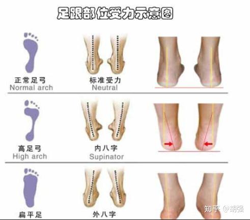 X型腿矫正训练 知乎