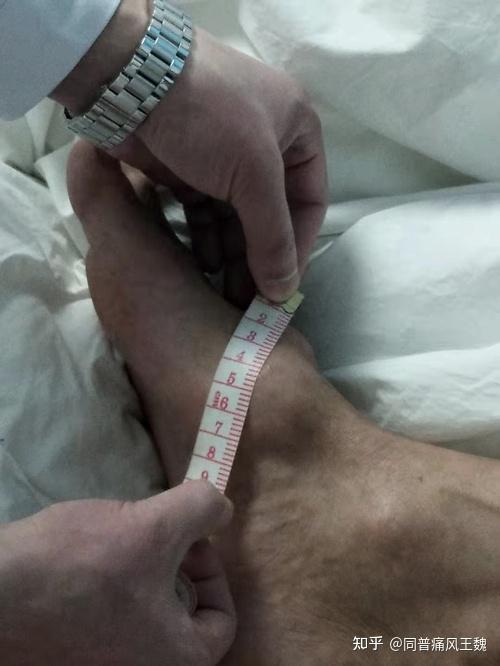 长期用饮料代水喝小伙右腿长满痛风石