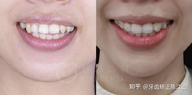 牙齿矫正丨笑线是什么？如何获得？ - 知乎