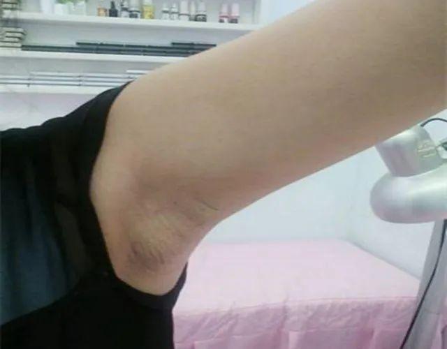 腋窝有包千万不要以为这是肥胖这是比肥胖严重得多的淋巴瘀堵一定要