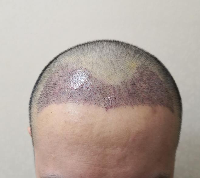 主流植发技术介绍 知乎