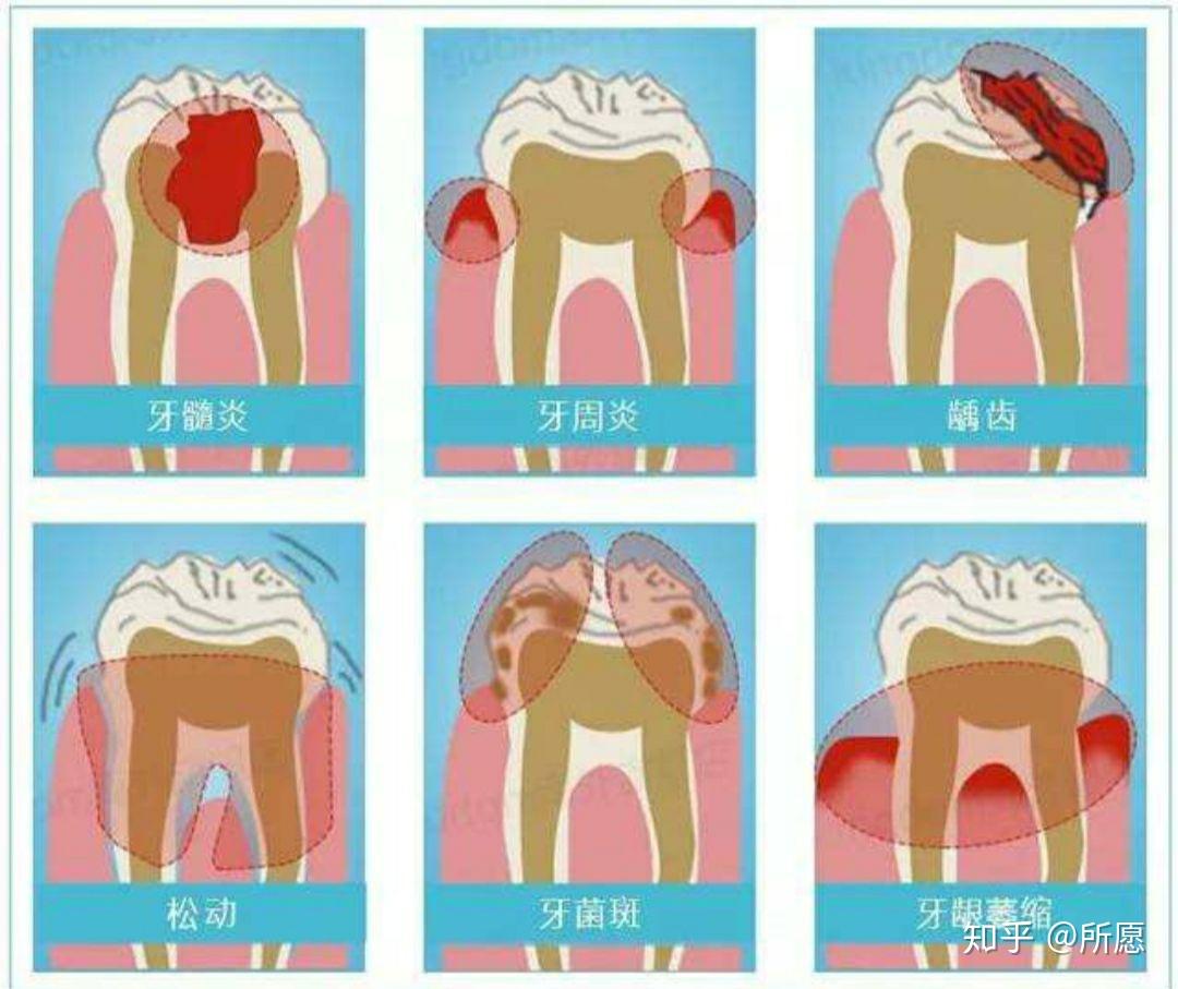 以及预防牙病的措施? - 知乎