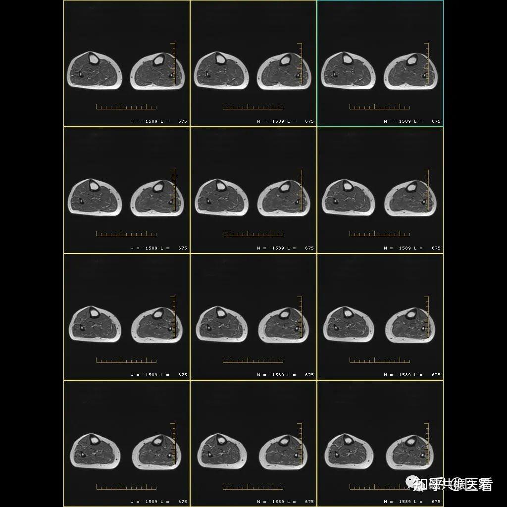 磁共振（MRI）四肢长骨、腿部扫描技术 - 知乎