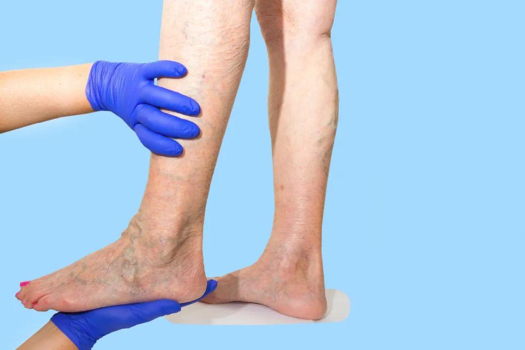 父母腿上的静脉曲张会遗传给我吗