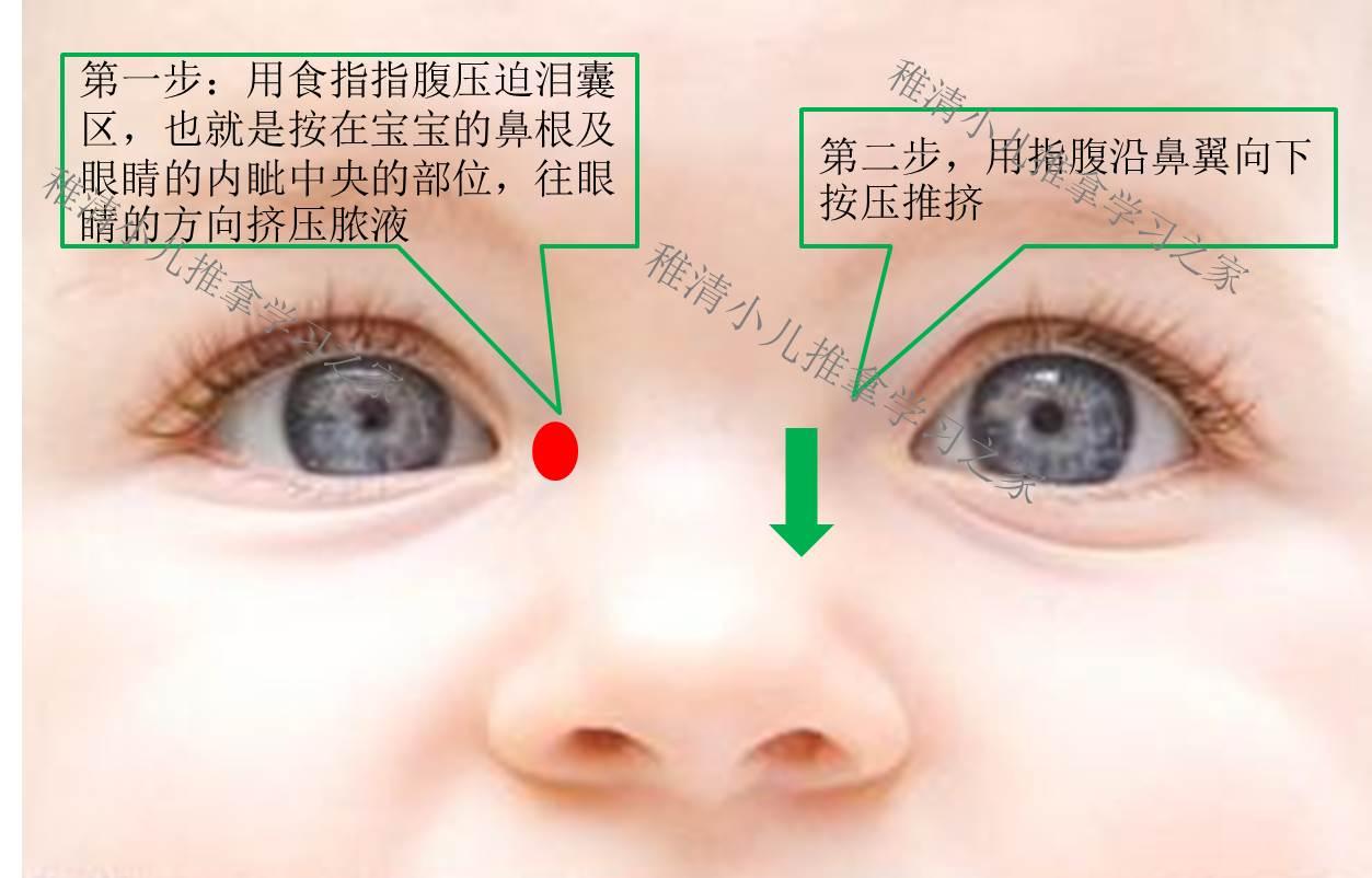 先天性鼻泪道阻塞的按摩方法 - 知乎