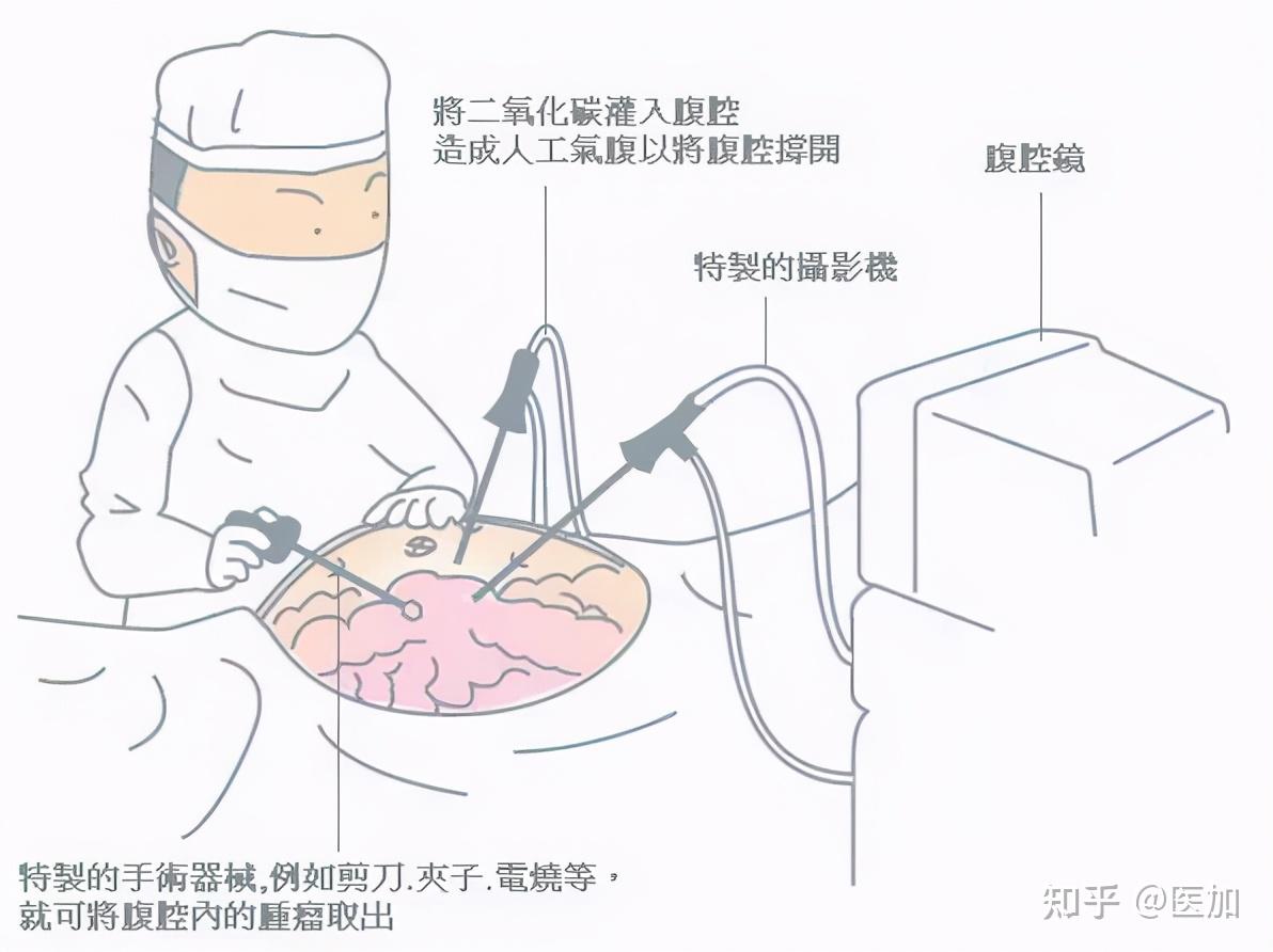 女孩子做完腹腔镜阑尾炎微创手术恢复全过程 - 知乎