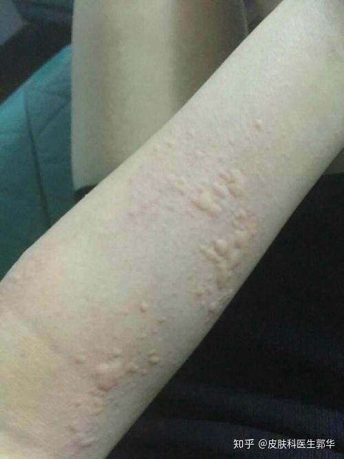 荨麻疹的治疗方法有哪些