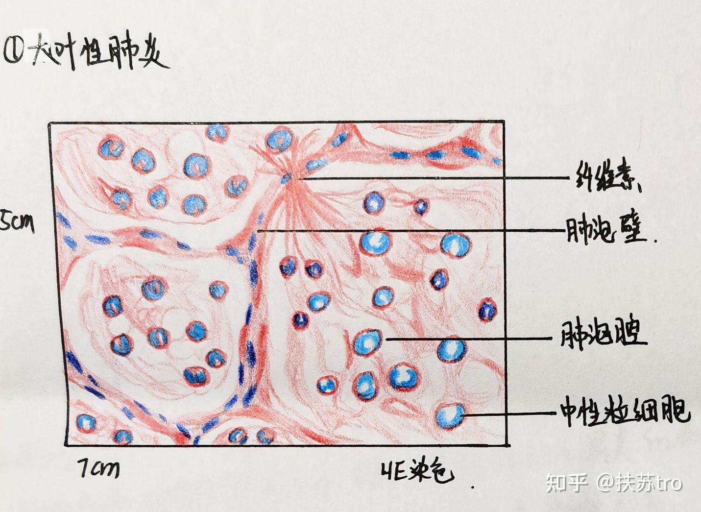 肺结核绘图红蓝铅笔图片