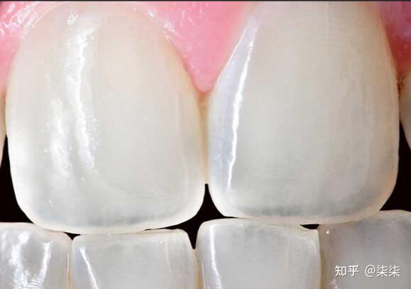 黄牙怎么也刷不白要怎么美白回来呢