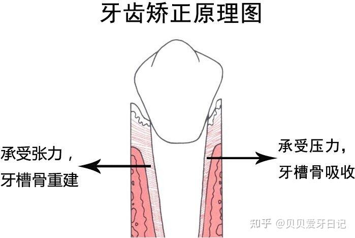 二次正畸沒那麼容易到底該如何避免二次正畸需要注意什麼