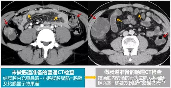炎症性肠病为何需要影像学检查 看仁济医院教授怎么说 知乎