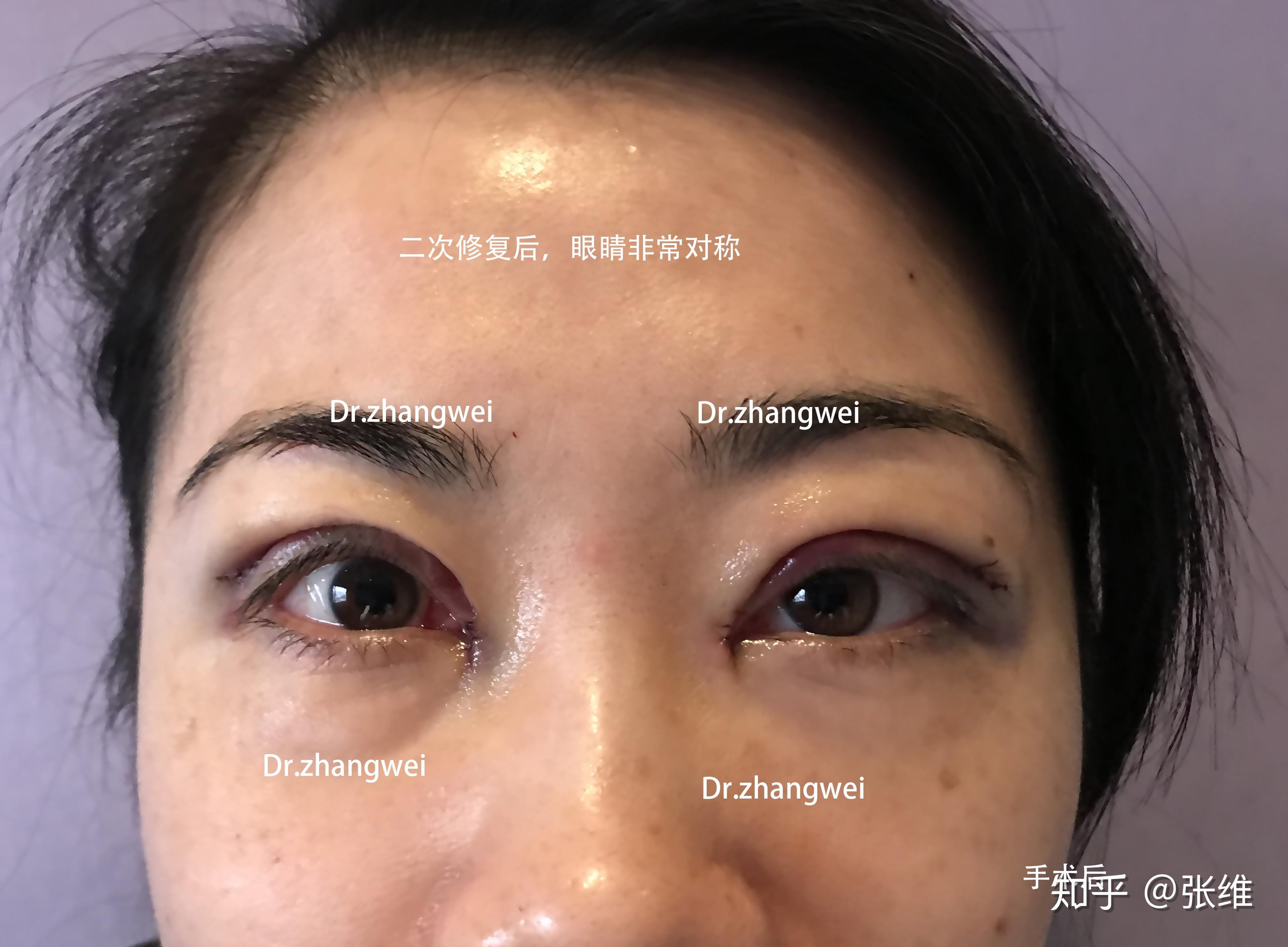 一侧双眼皮没做上去,另一侧双眼皮特别宽大,提肌的附着点以及