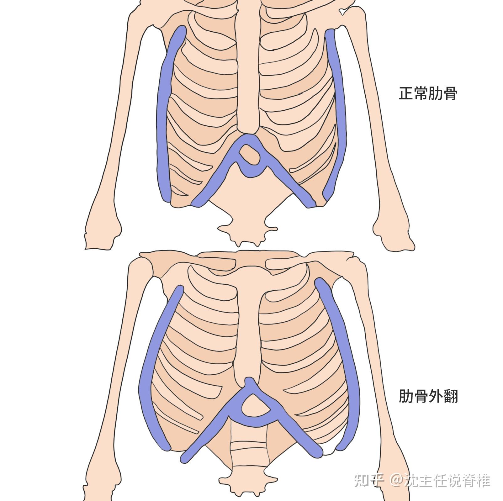 肋骨外翻症状图片