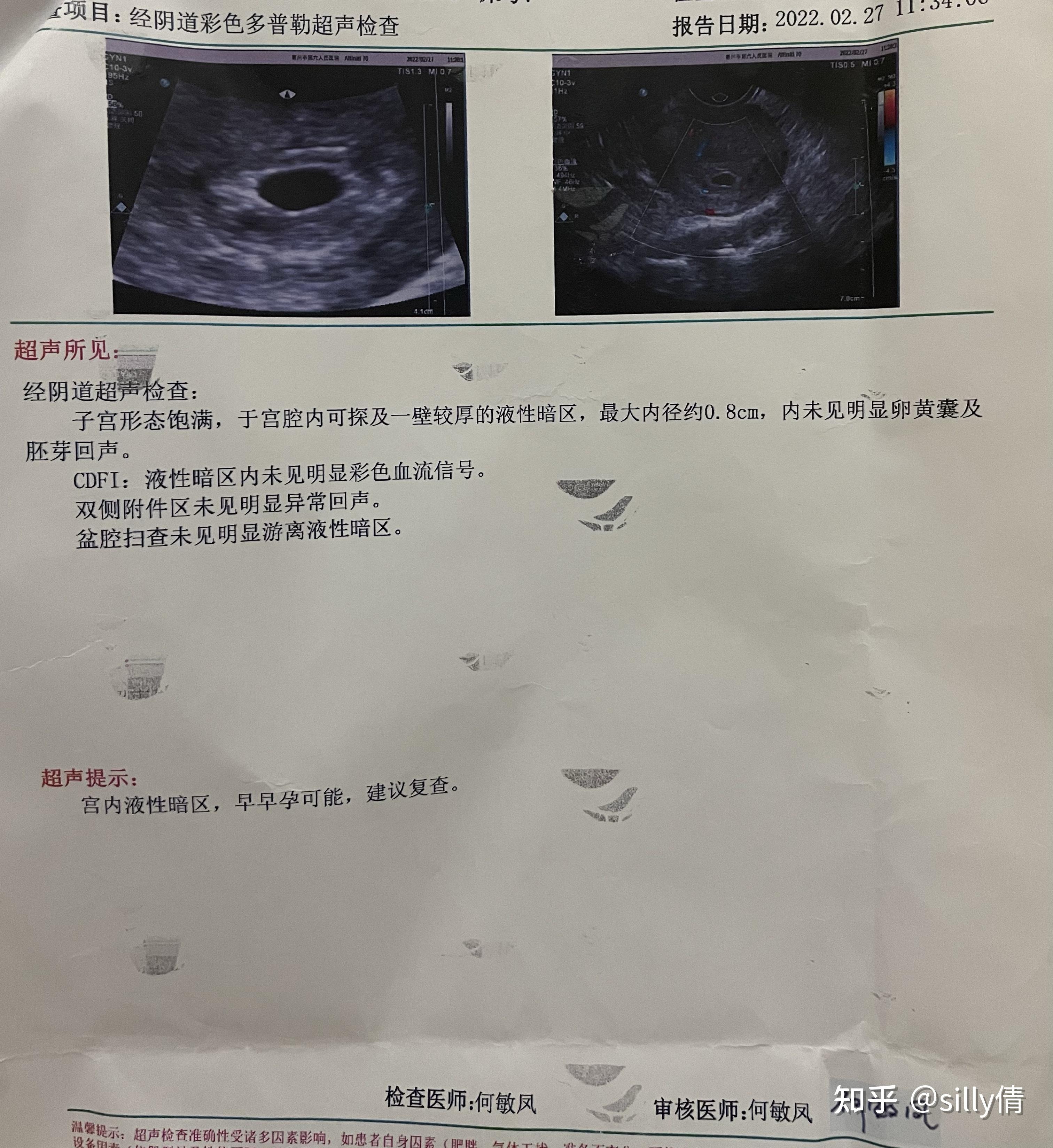 怀孕9周女孩孕囊图图片