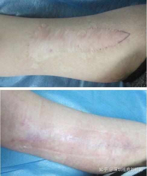 疤痕多久能自行消失 v2-dec4b71ab6ea54777a2c03d5e1c85c8d_r.jpg
