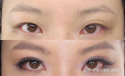 对照着瞧瞧吧!南京玖熙医疗美容1,肿泡眼肿泡眼就是