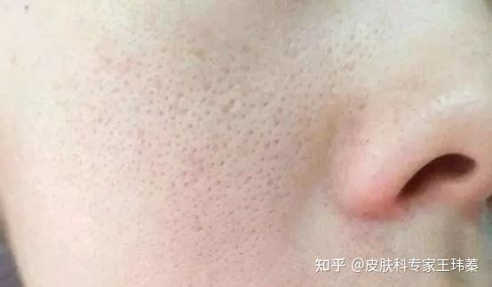 你知道毛孔粗大是怎么回事吗 知乎 你知道毛孔粗大是怎么回事吗 知乎