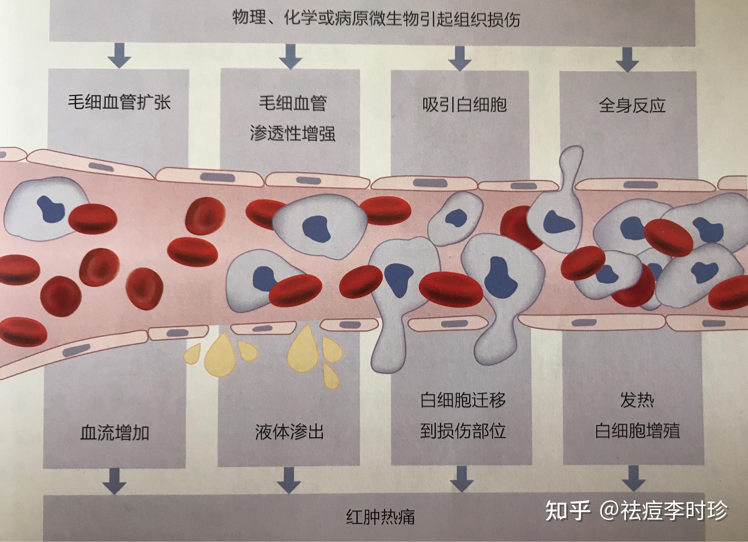 各种细胞因子,补体,白介素,趋化因子,中性粒细胞等参与炎症反应,痤疮