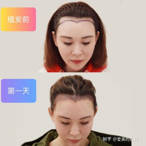 上海华三植发(华西植发找哪个医生)