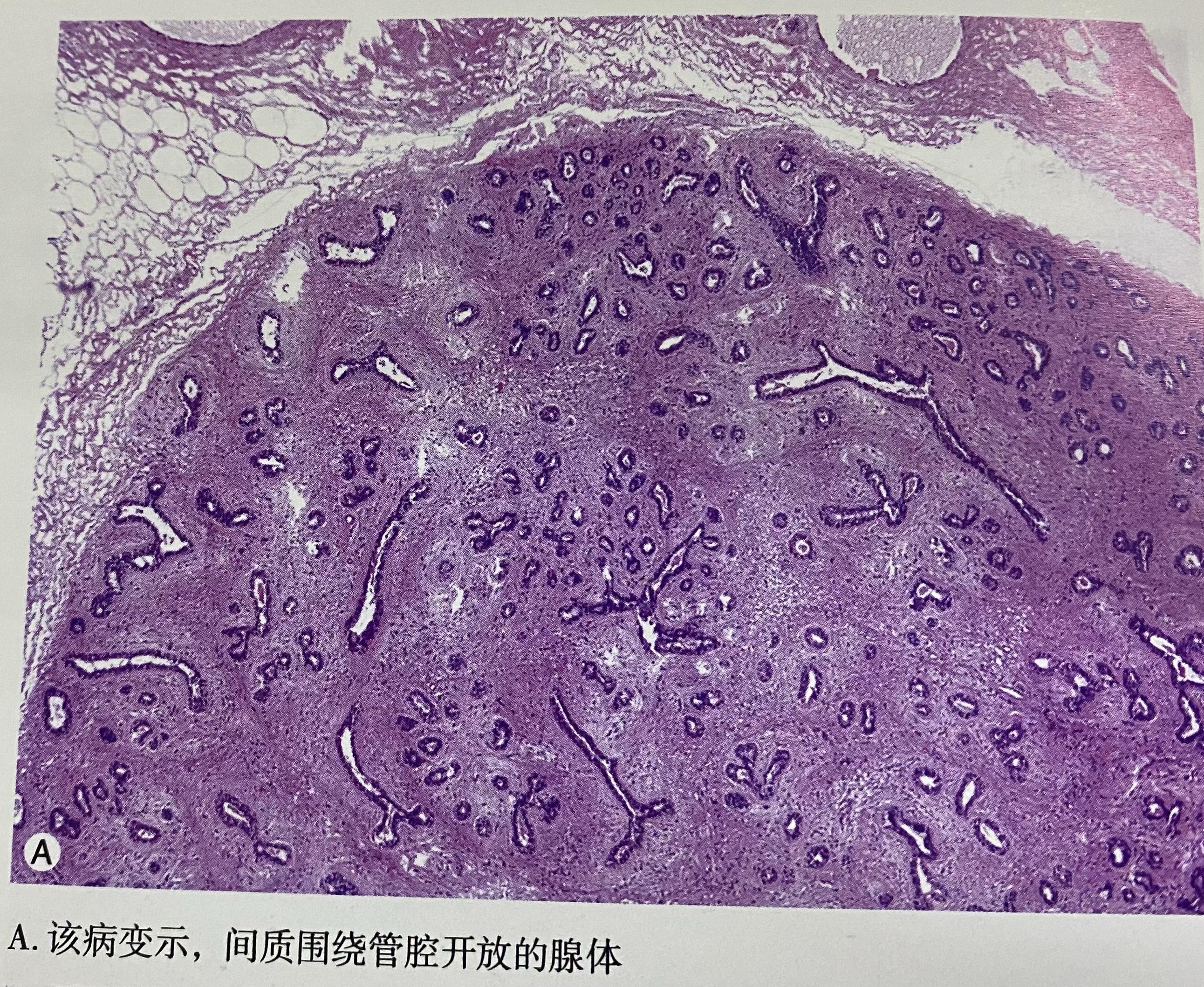 乳腺纤维腺瘤病理图片