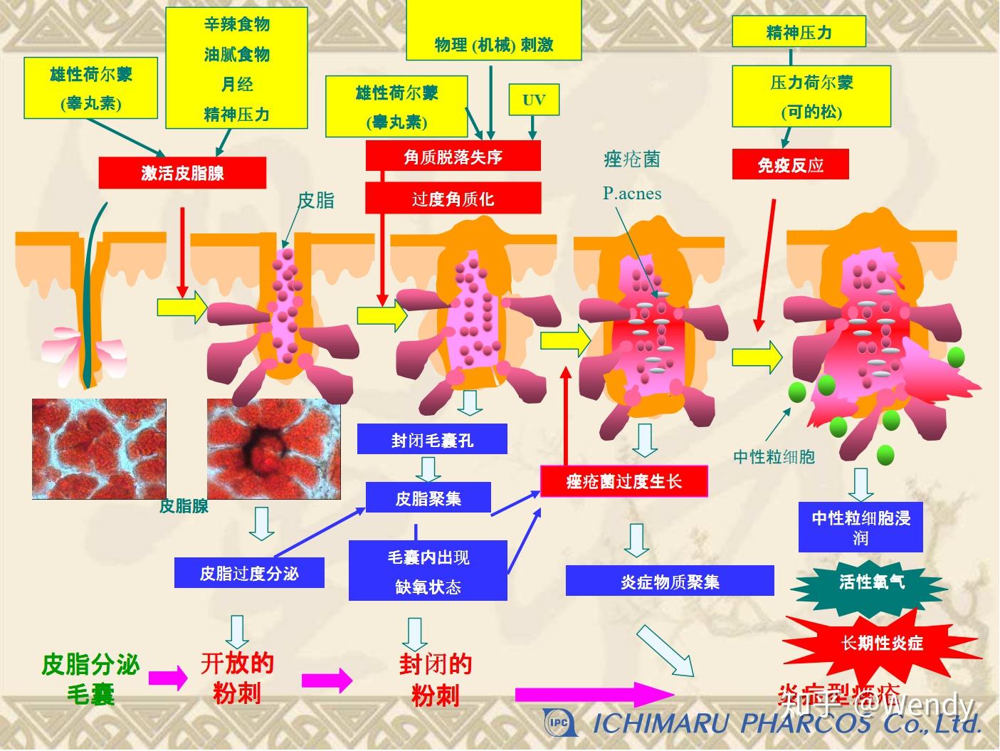 痤疮的形成机理和分类 - 知乎