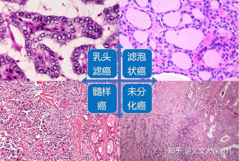 甲状腺癌在病理上,通常分为四种类型