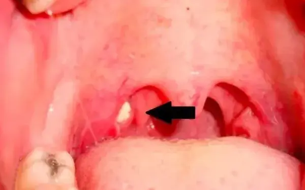 让人口臭的结石不止长在牙上 扁桃体也有 知乎 让人口臭的结石不止长在牙上 扁桃体也有 知乎