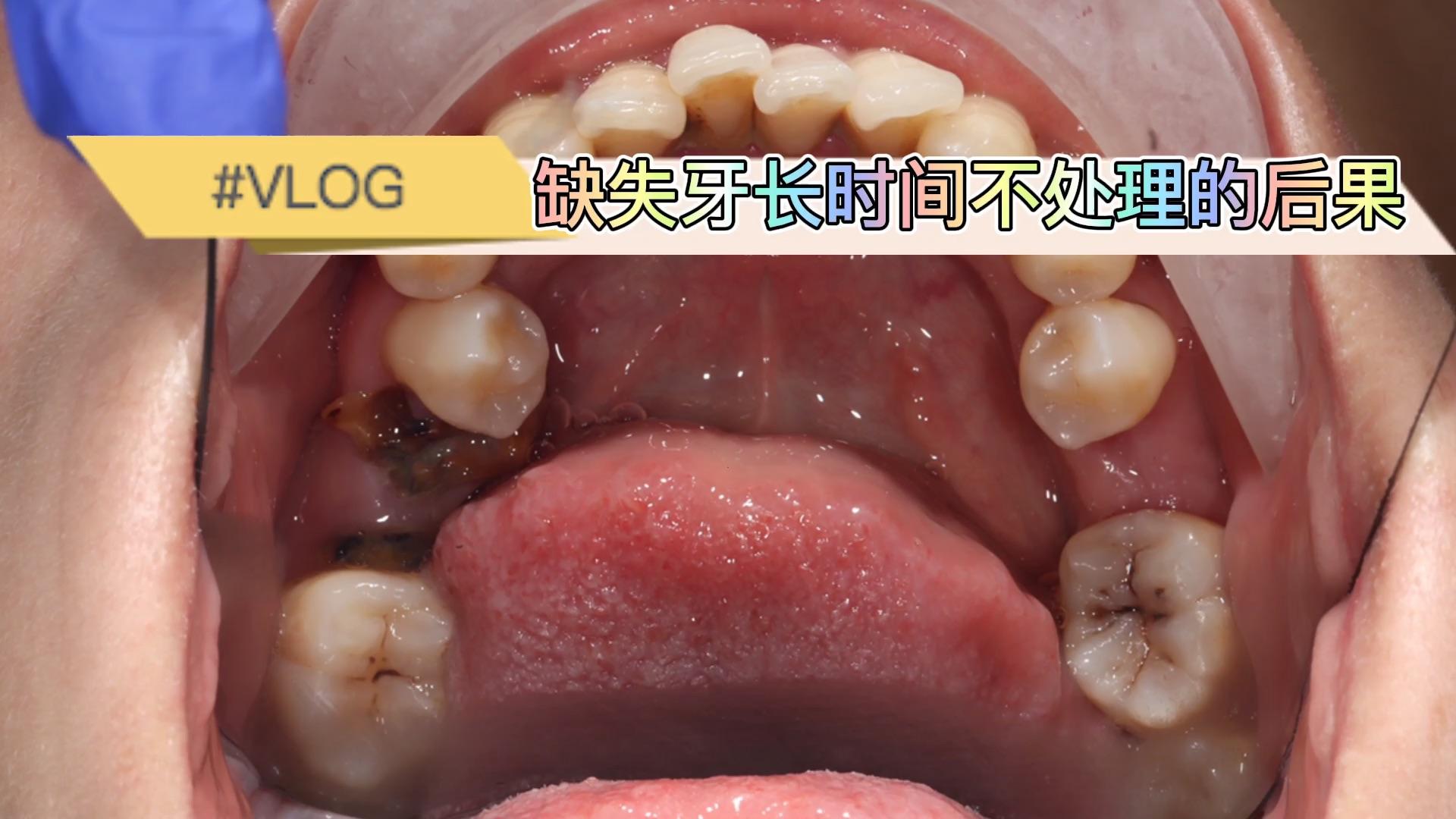 最后被发现的时候是因为牙齿疼痛敏感或者咬合面塌陷形成了一个大洞